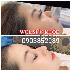 Spa Tiêm Filler Uy Tín Quận 6